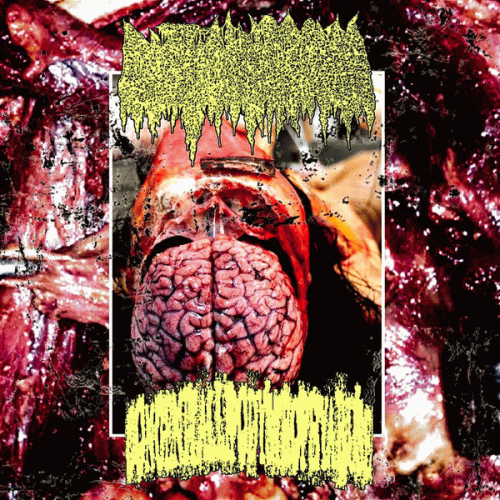 Cystic Hygroma : Congenital Lipodystrophy Abuse - Cystic Hygroma